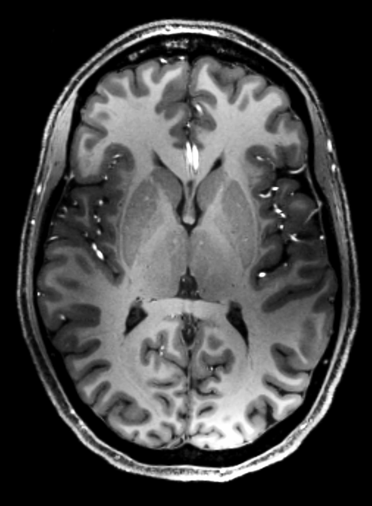Axial MRI