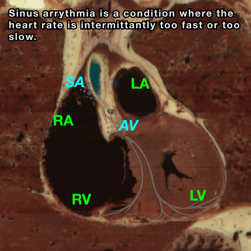 Sinus Arrythmia