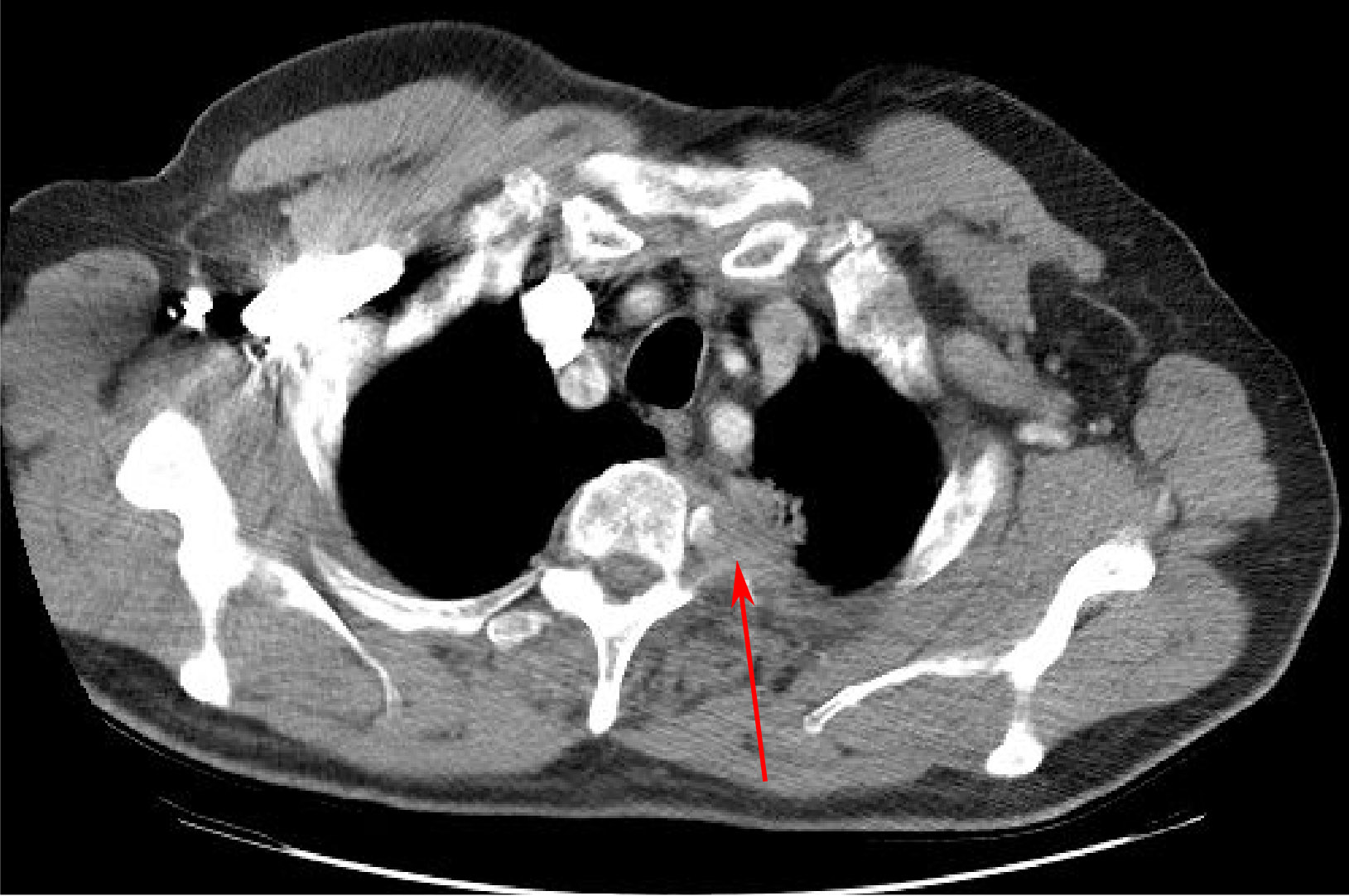 Pancoast Tumor CT