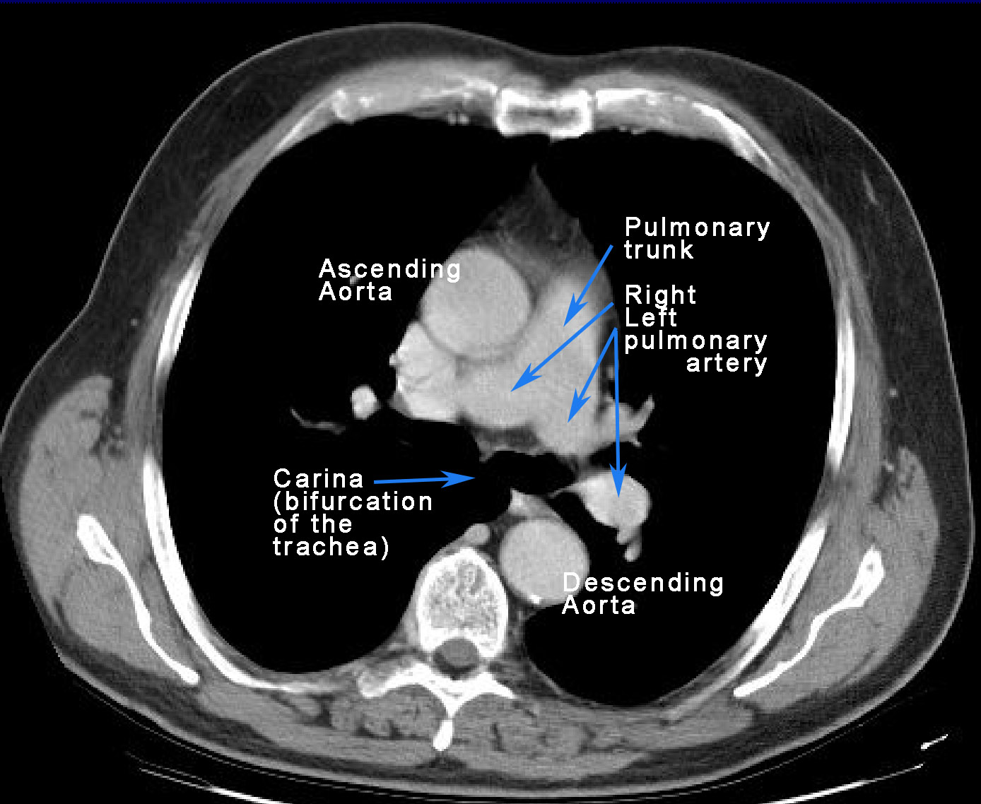 Pulmonary Artery CT