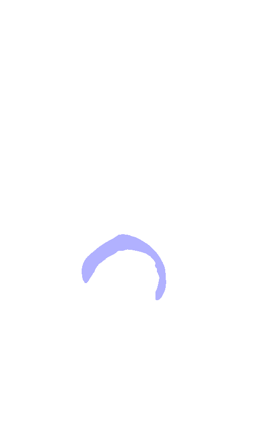 Intcondylar Fossa