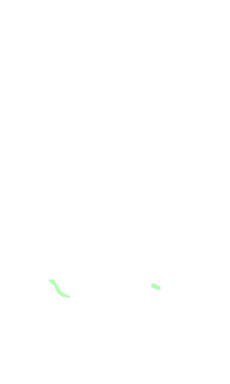 Glossopharyngeal