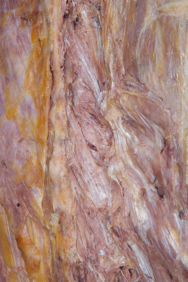 Right Rotatores Muscles (semispinalis and multifidus removed)