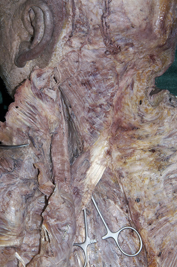 Serratus Posterior Superior Muscle