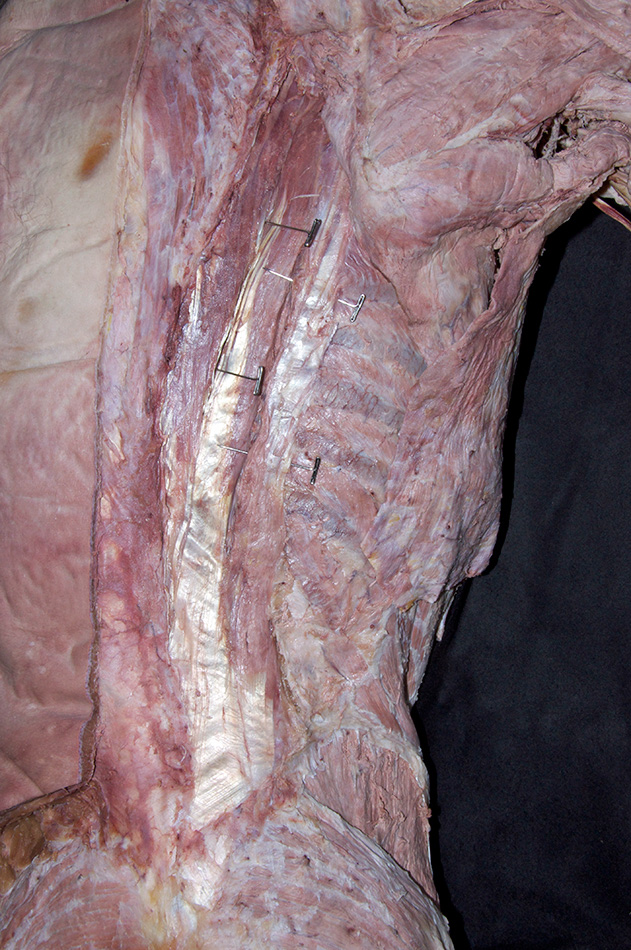 Erector Spinae Muscles