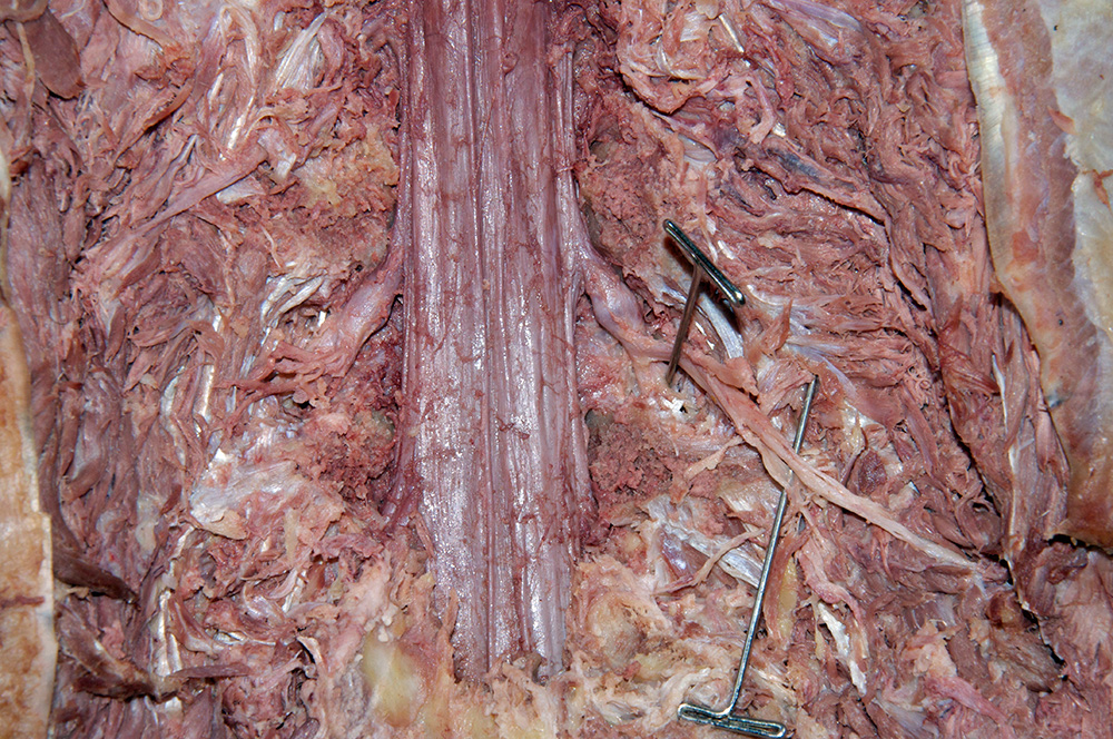 Dorsal Root Ganglion