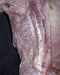 Erector Spinae Muscles