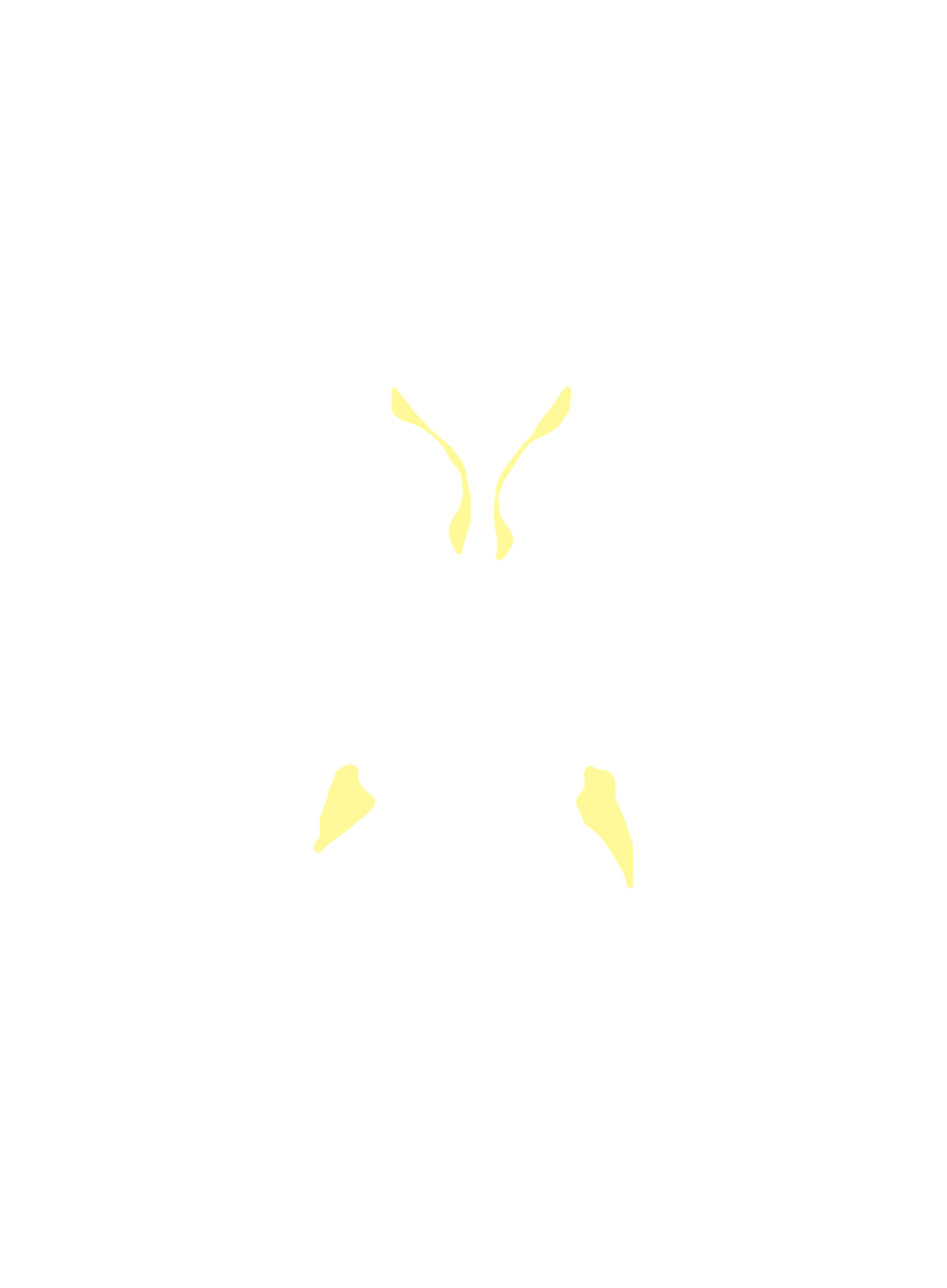 Lateral ventricle