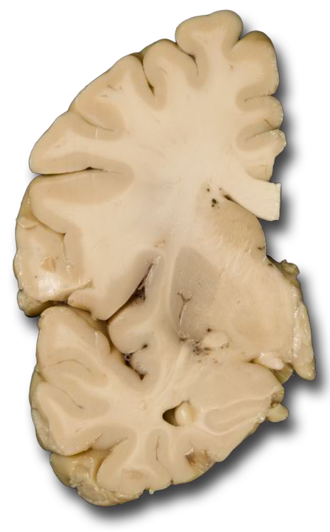 Coronal anterior