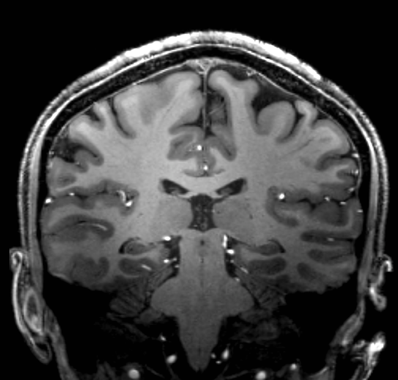 Coronal MRI