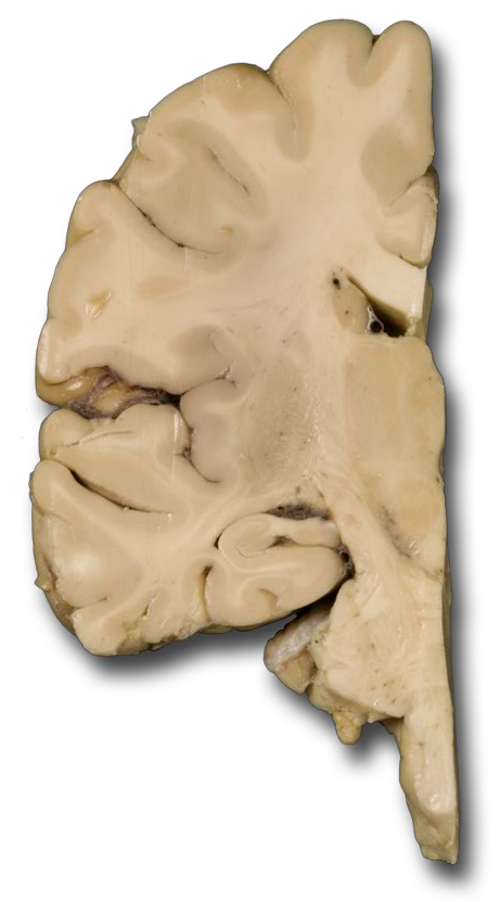 Coronal posterior