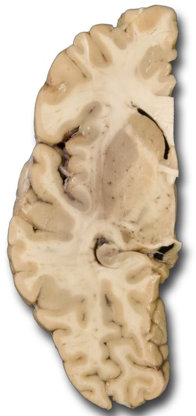 Transverse inferior