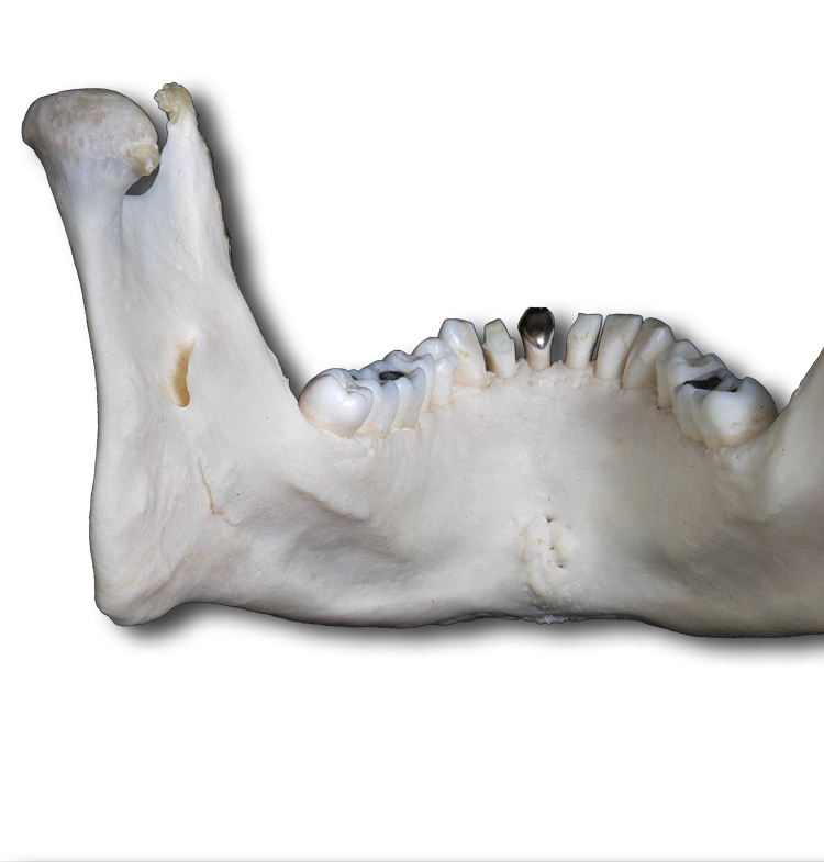 Mandible - Posterior View