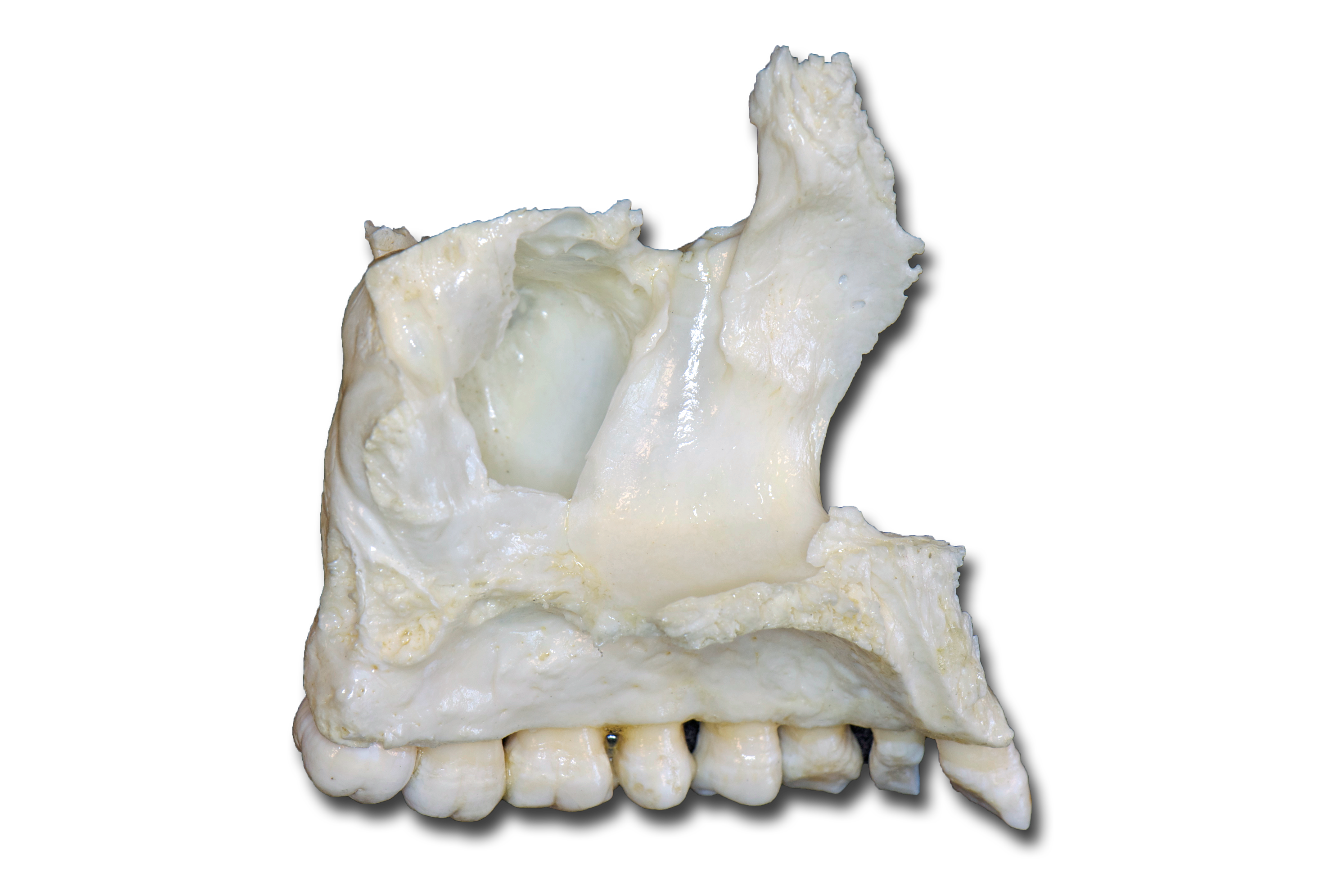 Maxilla left medial