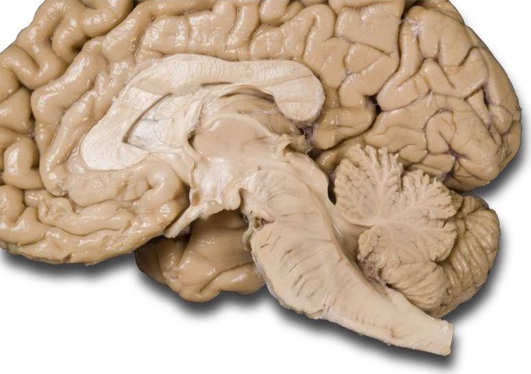 Mid sagittal ventricles