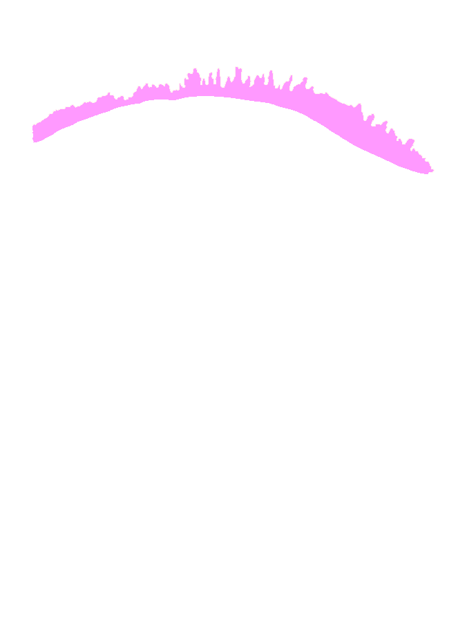 Superior Sagittal Sinus Groove