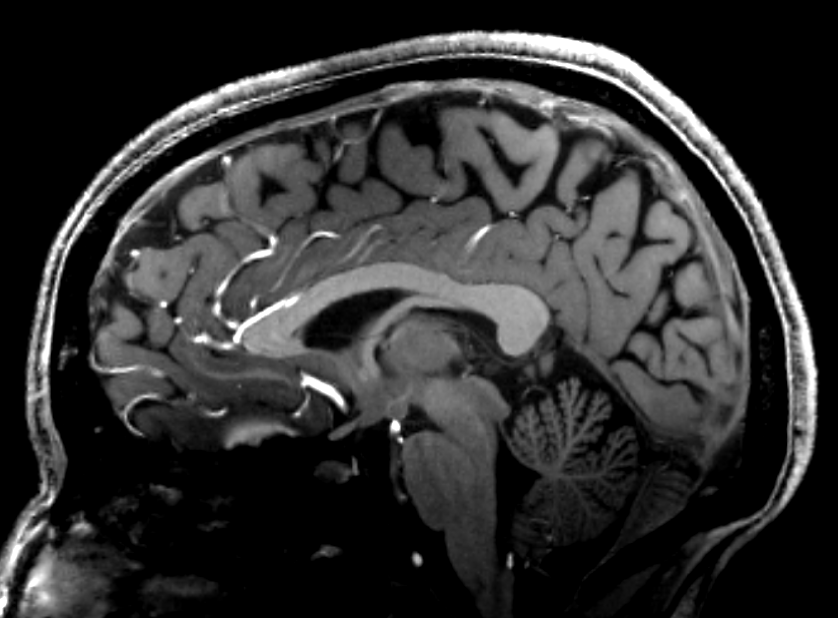 Sagittal MRI