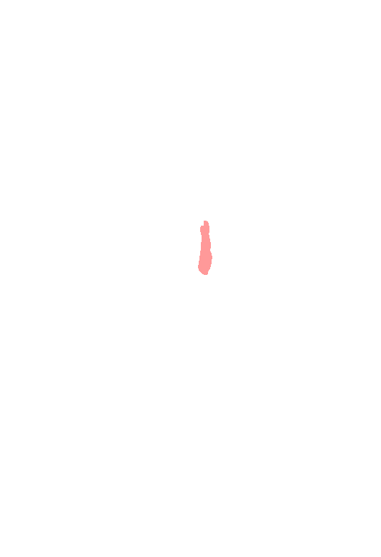 Orbital surface lacrimal