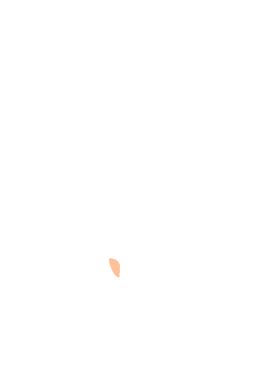 Tuberosity maxilla