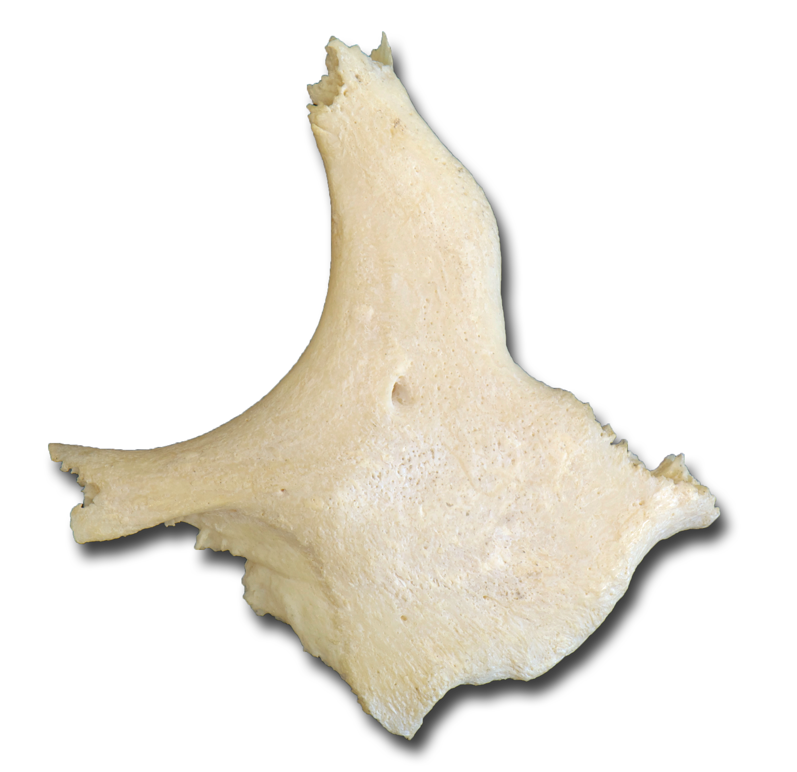 Zygomatic lateral