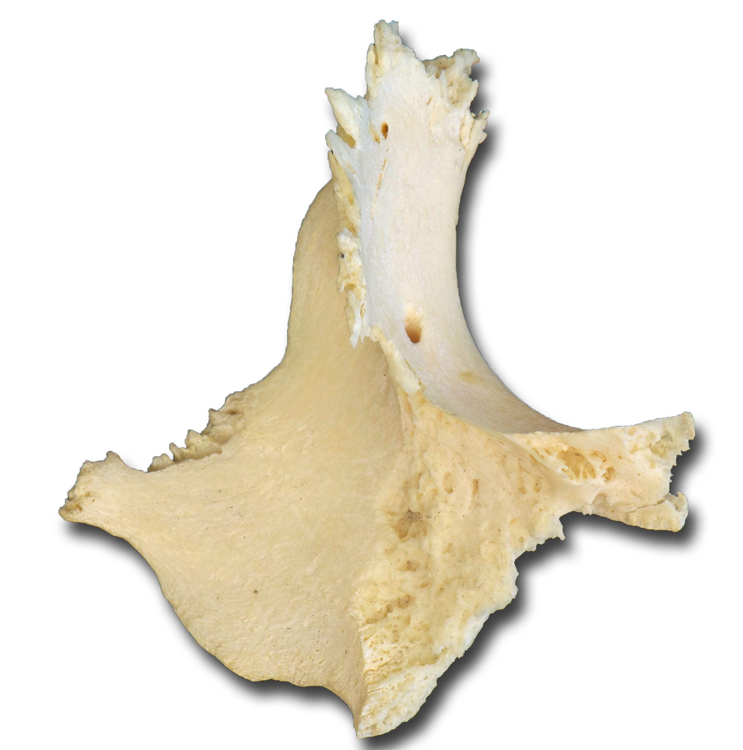 Zygomatic medial