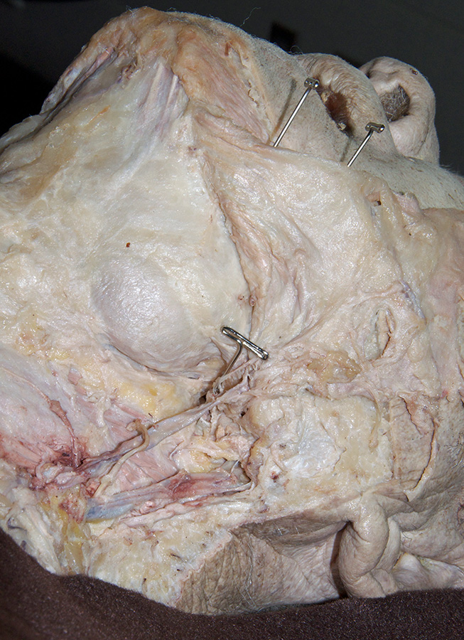 Platysma Muscle Reflected