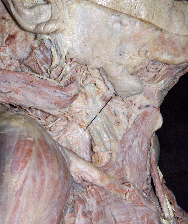 Ansa Cervicalis and Carotid Sheath