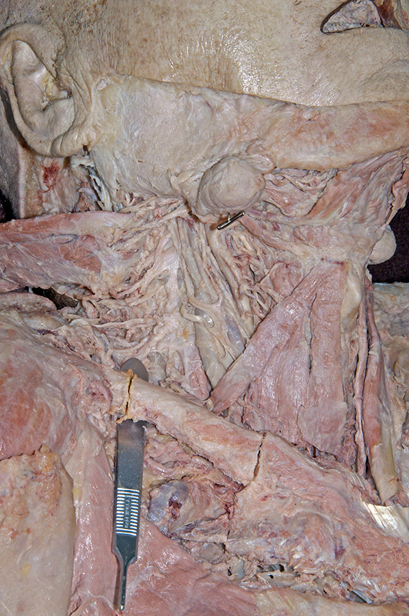 Lateral Cut in Clavicle