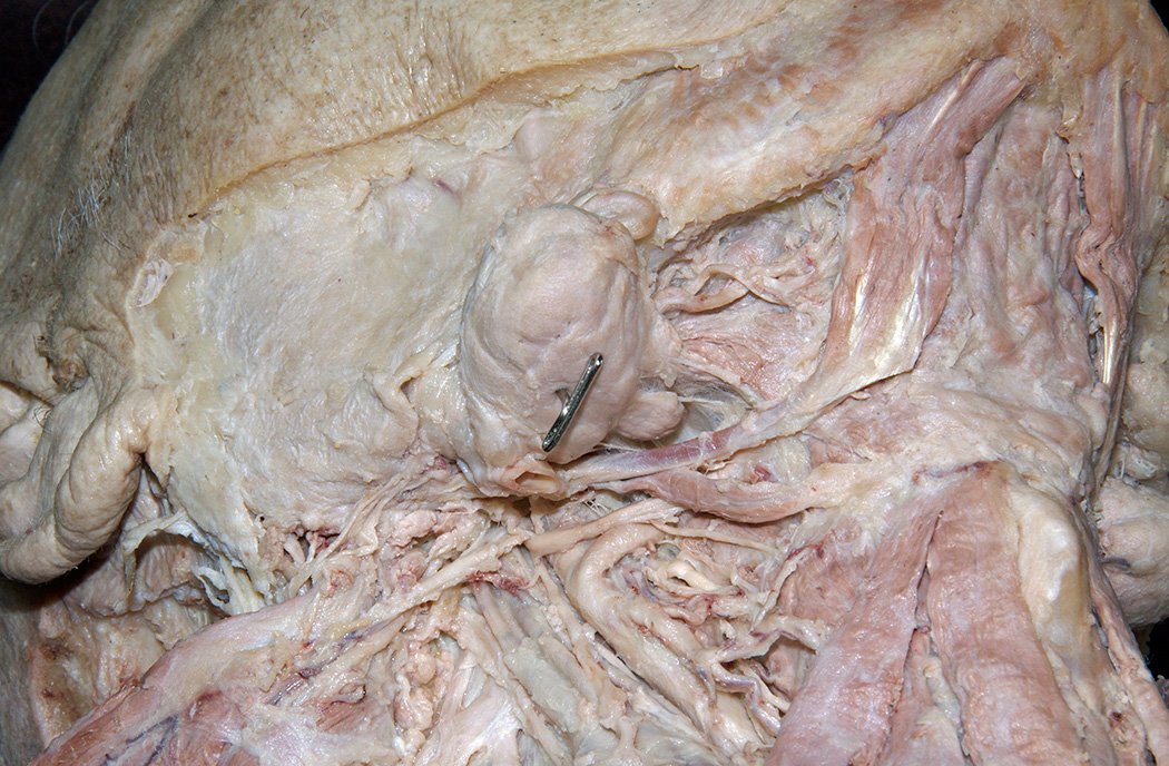 Stylohyoid Muscle