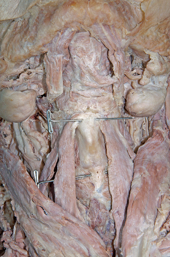 Thyroid Cartilage