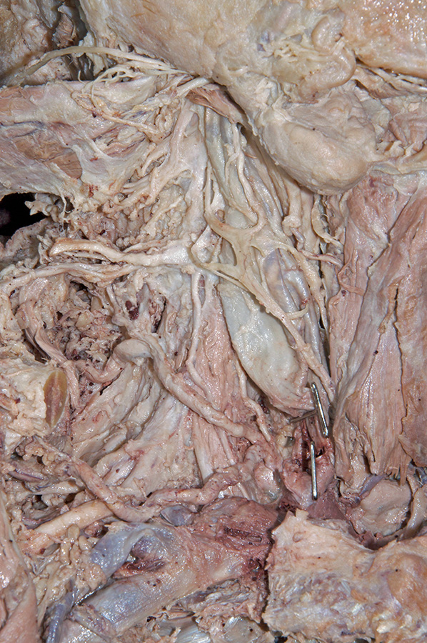Transverse Cervical Artery
