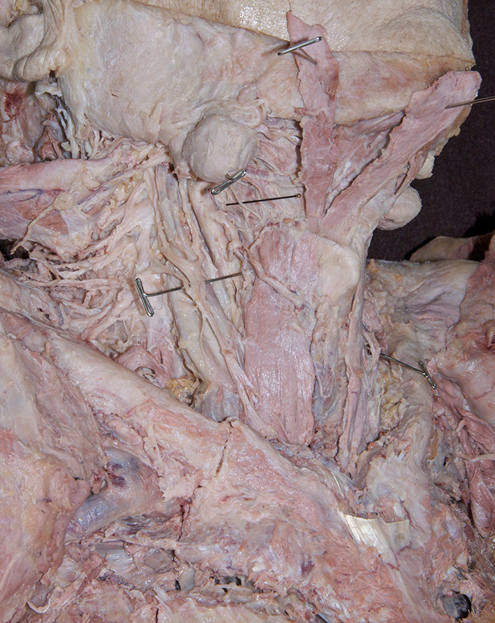 Reflected Omohyoid Muscle