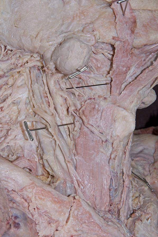 Sternothyroid and Thyrohyoid Muscles