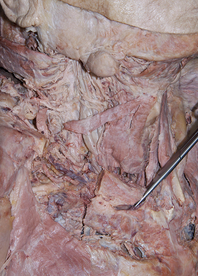 Sternoclavicular Joint