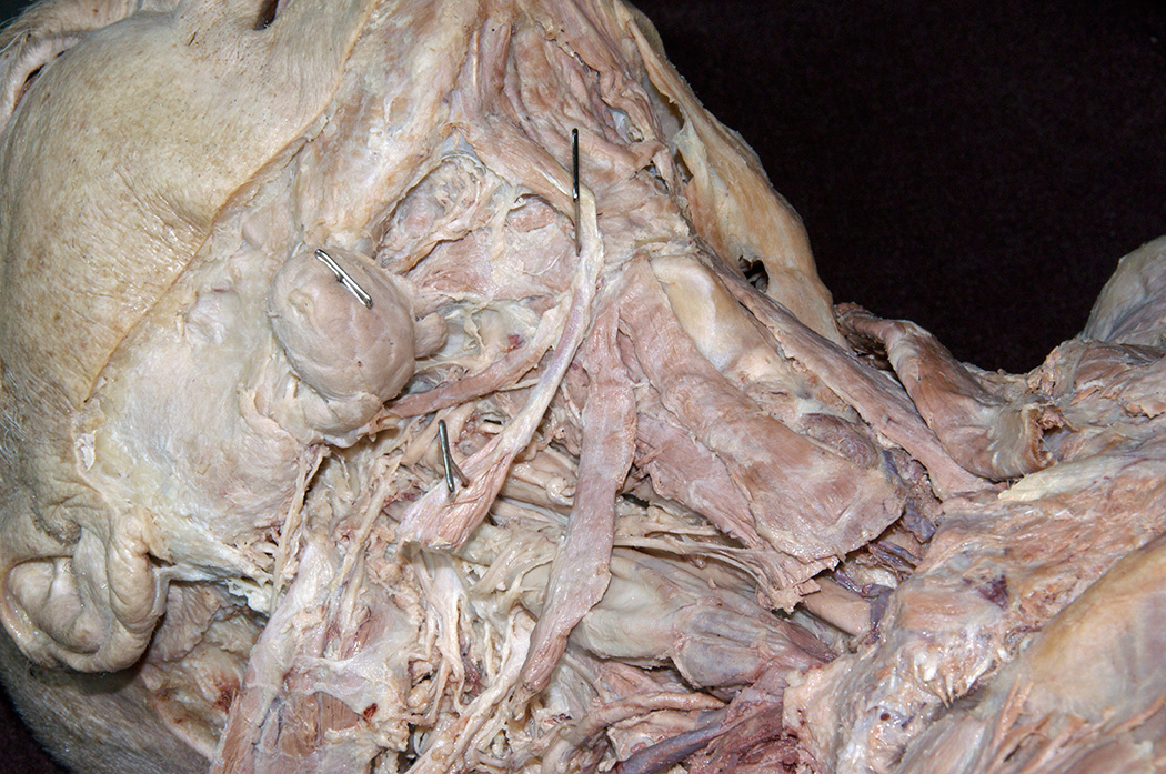 Digastric (Posterior Belly) Muscle