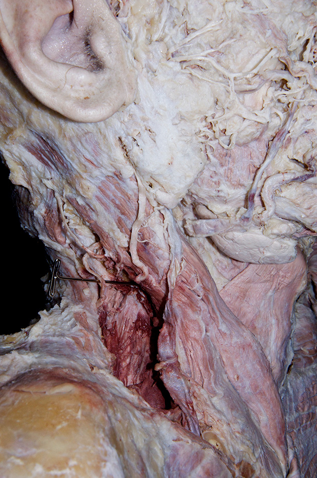 Accessory Nerve