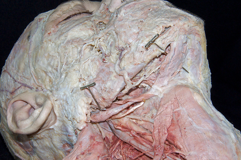 Digastric Muscle