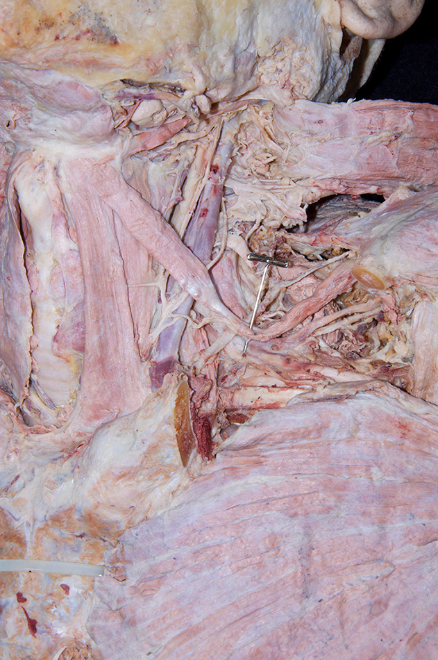 Omohyoid Muscle