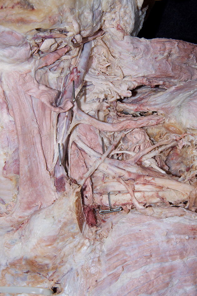 Anterior Scalene Muscle