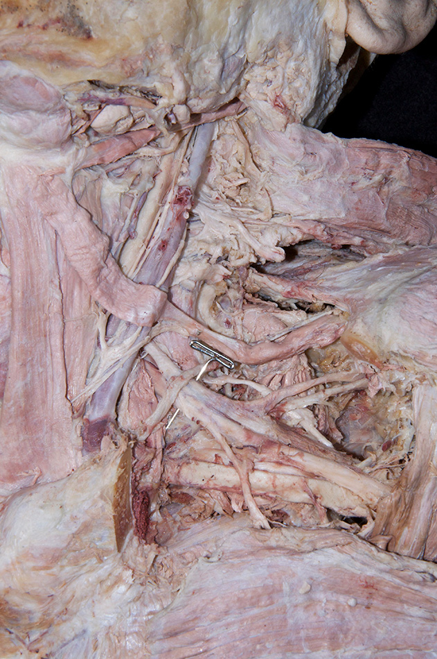 Suprascapular Nerve