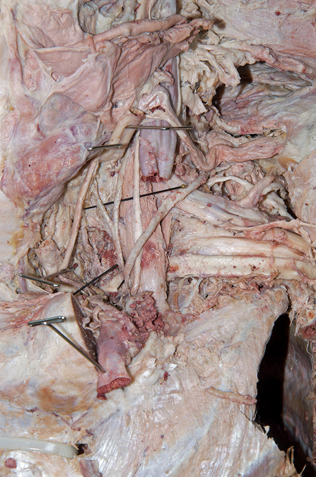 Phrenic Nerve