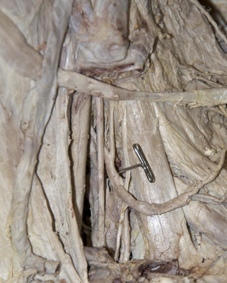 Left Thyrocervical Trunk (superior to the top)