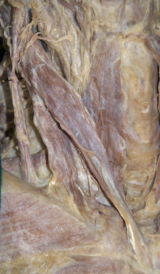 Right Sternocleidomastoid Muscle (superior to the top)