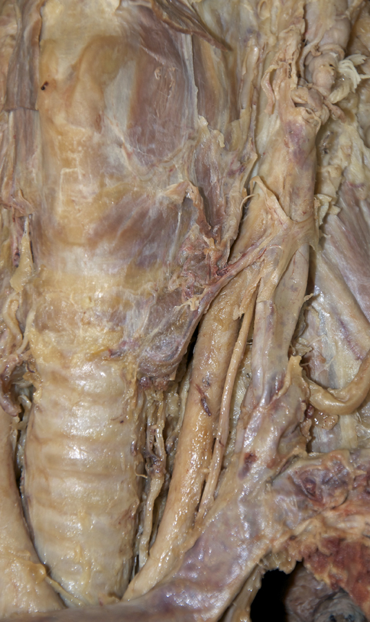 Left Recurrent Laryngeal Nerve