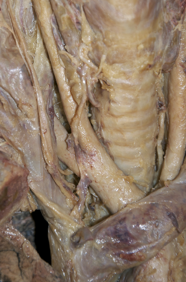 Right Recurrent Laryngeal Nerve (origin)