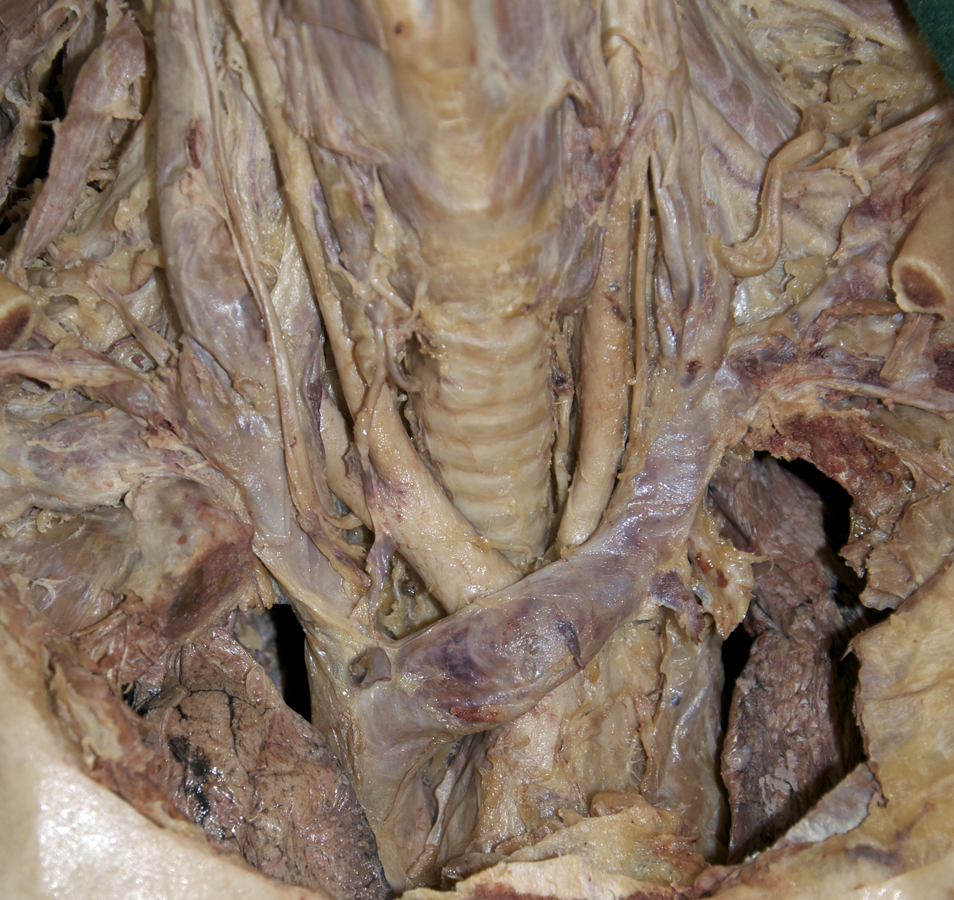 Brachiocephalic Veins