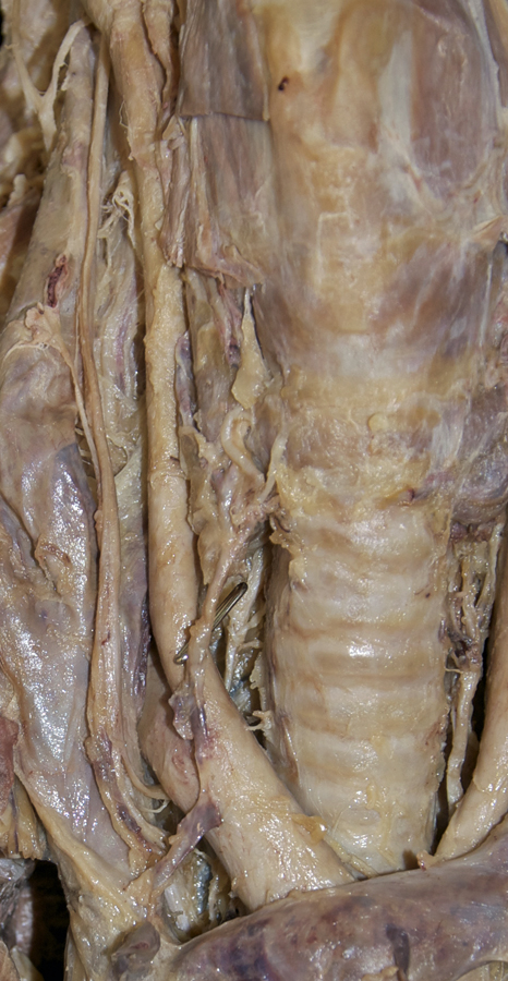 Right Recurrent Laryngeal Nerve (in tracheoesophageal groove)