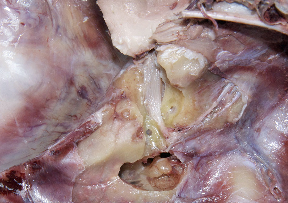 Petrosal Nerves (a portion of the temporal bone was removed)