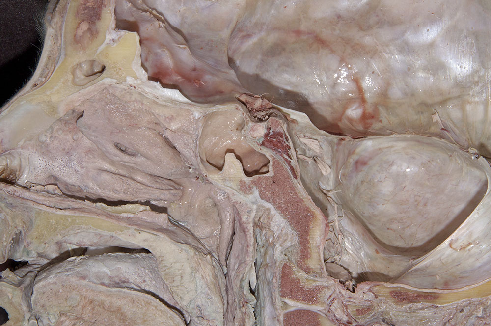 Cavernous Sinus