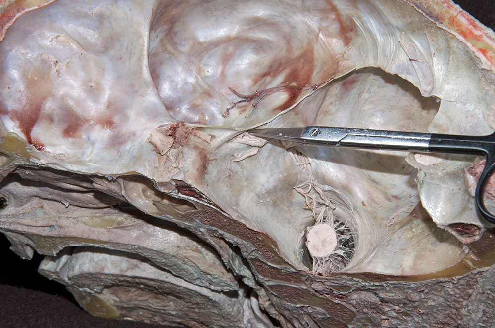 Exposing the Trigeminal Ganglion
